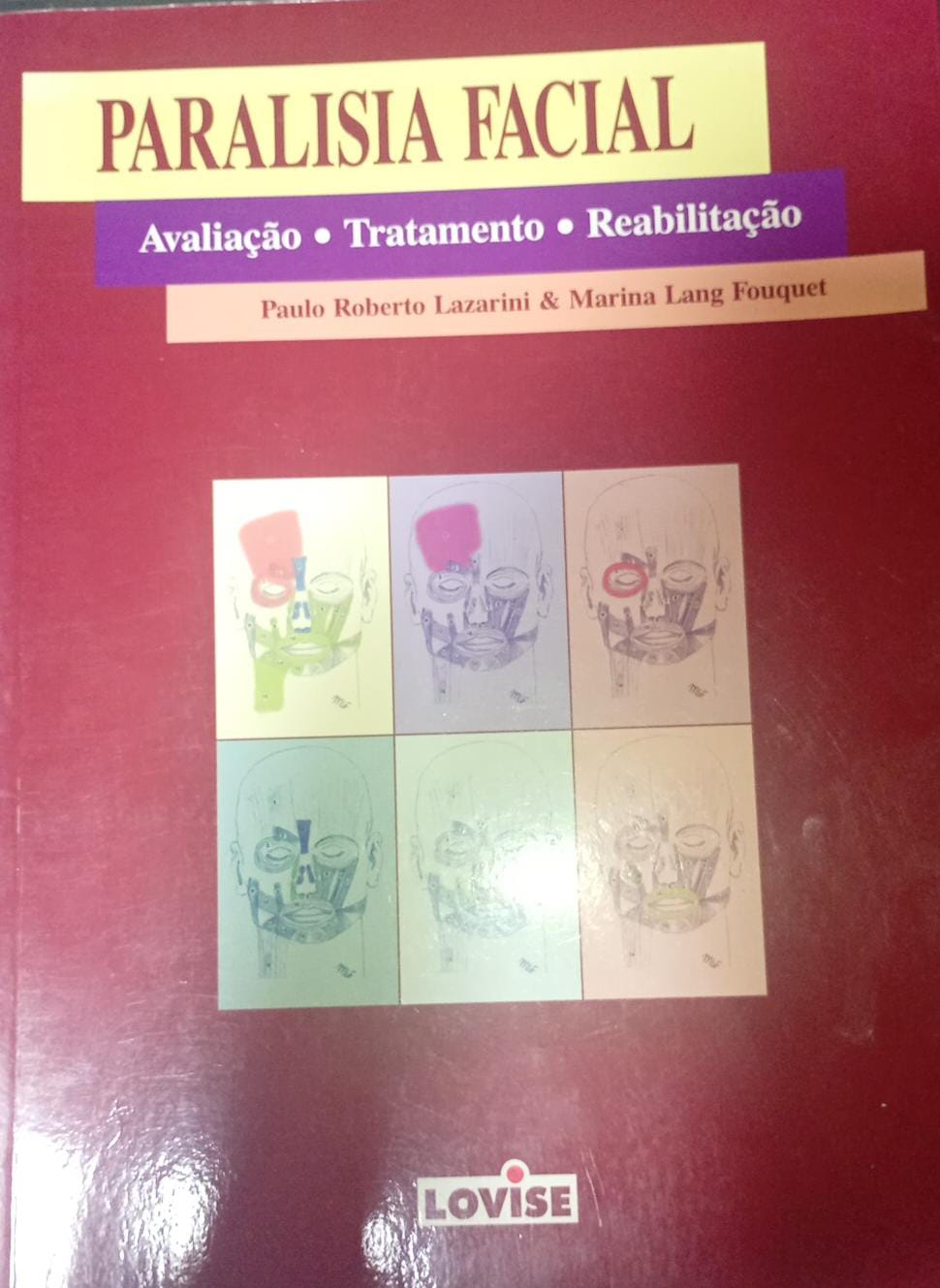Paralisia Facial